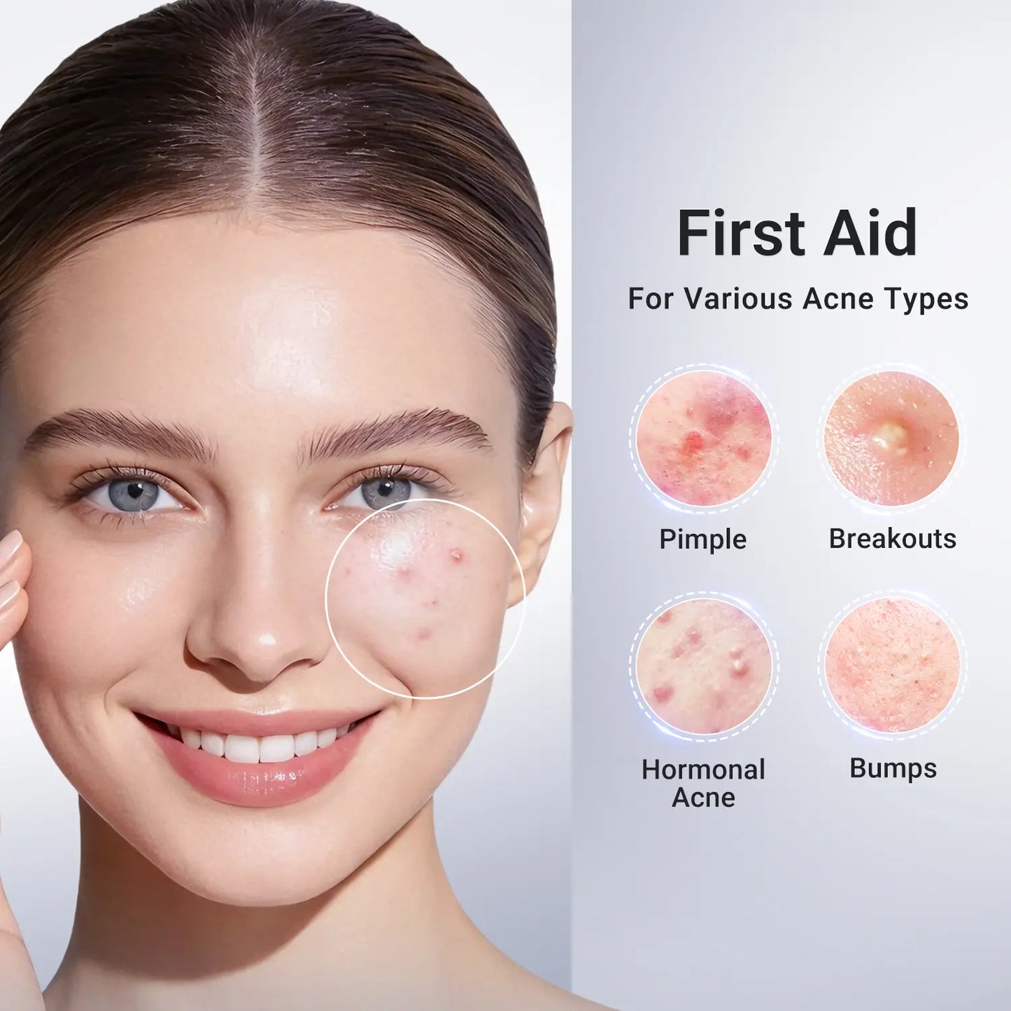 Acne Treatment Lotion | 24H Pimple Care & 7-Day Scar Fade | 1.8% Salicylic Acid, 4% Niacinamide & 10% Sulfur