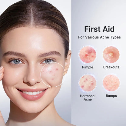 Acne Treatment Lotion | 24H Pimple Care & 7-Day Scar Fade | 1.8% Salicylic Acid, 4% Niacinamide & 10% Sulfur
