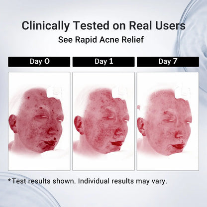 Acne Treatment Lotion | 24H Pimple Care & 7-Day Scar Fade | 1.8% Salicylic Acid, 4% Niacinamide & 10% Sulfur
